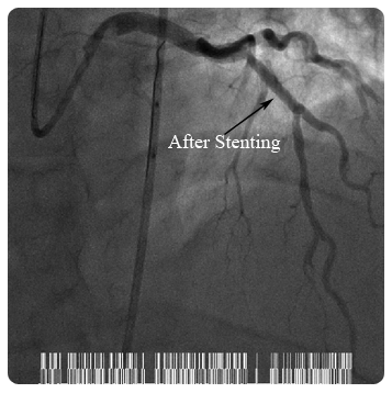 After Stenting
