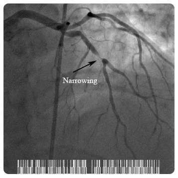 narrowing arteries